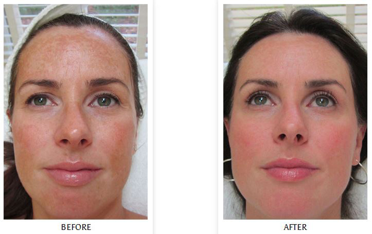 http://www.ayrejuvenation.ca/wp-content/uploads/2018/06/new-medical-grade-chemical-peels-image.jpg